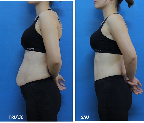 Trước và sau khi giảm mỡ bụng bằng công nghệ 3D Lipo