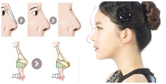 Nâng mũi bọc sụn tự thân giúp bọc và bảo vệ mũi khỏi biến chứng