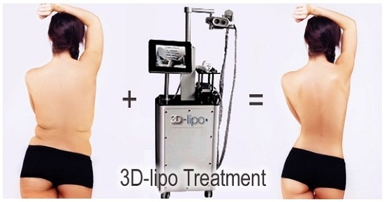 Công nghệ hút mỡ bụng 3D Lipo được nhiều người yêu thích nhất hiện nay