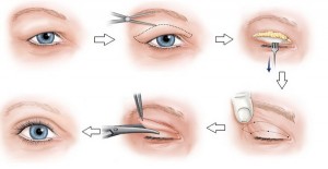 Cách tạo mắt 2 mí tự nhiên bằng cắt mí mắt 1