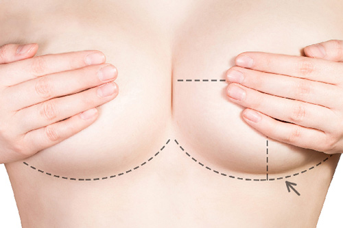 Nâng ngực nội soi giá bao nhiêu, có đau không, có an toàn không? 4