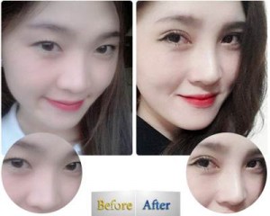 Sự khác nhau giữa bấm mí mắt và cắt mí mắt Hàn Quốc 3