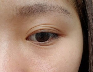 Nguyên nhân gây mắt ba mí và cách chữa, phòng tránh hiệu quả 1