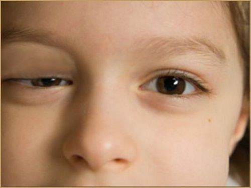 Sụp mí mắt ở trẻ em có phẫu thuật thẩm mỹ được không? 1