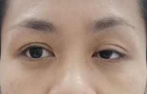 Thuốc chữa sụp mí mắt có hiệu quả không? 