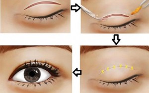 Giải đáp thắc mắc về 3 vấn đề cắt mí mắt thường gặp nhất 1