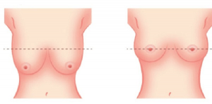 Hỏi – Đáp một số vấn đề của nâng ngực sa trễ và nâng ngực sa trễ sau sinh 1
