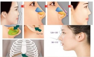Một số vấn đề quan trọng cần biết về nâng mũi bằng sụn tự thân 2