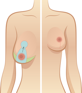 Hỏi – Đáp nâng ngực sa trễ có sẹo không, giá bao nhiêu, nâng ngực sa trễ sau sinh có thực sự đẹp không 1
