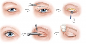 Tổng hợp các phương pháp lấy mỡ mắt chống sụp mí 1